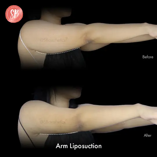 Arm Liposution