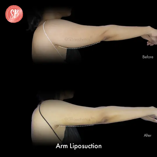 Arm Liposution