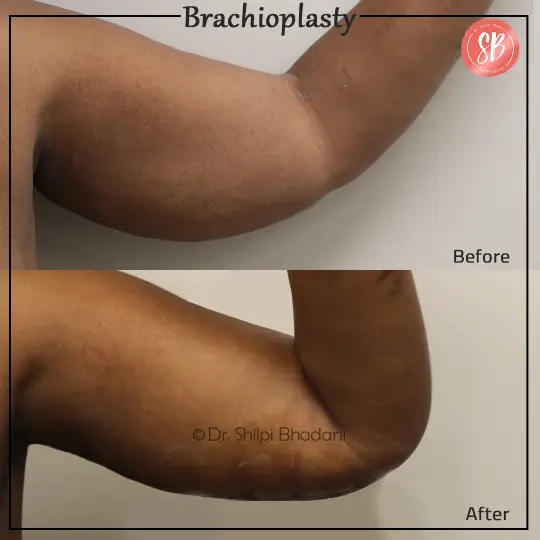 Arm Liposution