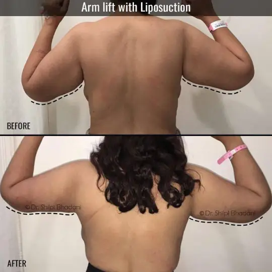 Arm Liposution