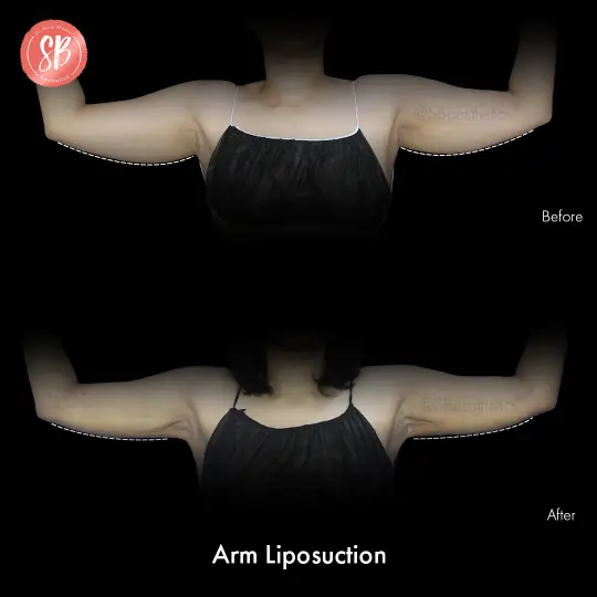 Arm Liposution