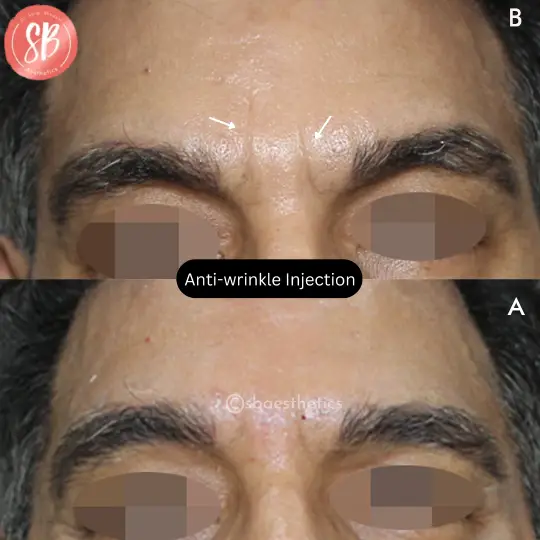 Anti Wrinkle Injections