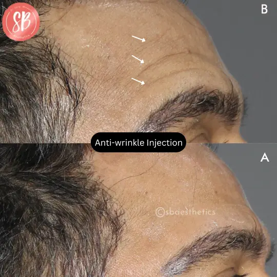 Anti Wrinkle Injections