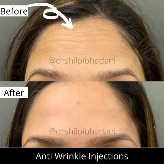 Anti Wrinkle Injections