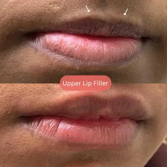 Lip FIller