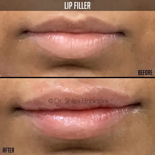 Lip FIller