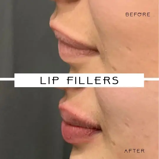 Lip FIller