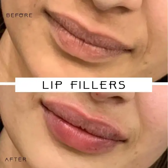 Lip FIller