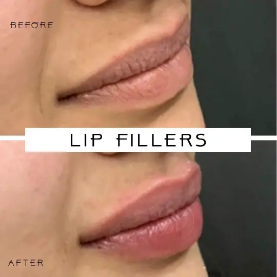 Lip FIller