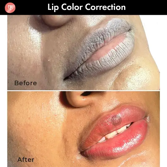 Lip FIller