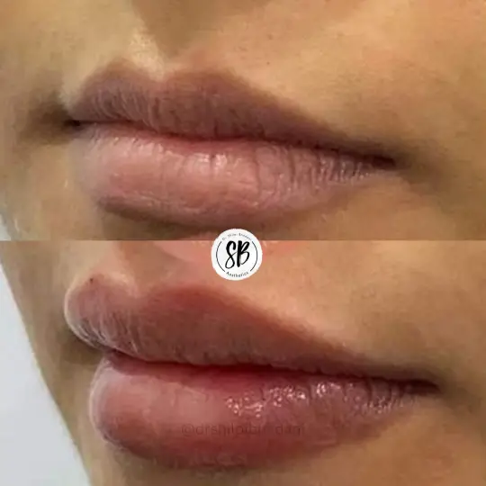 Lip FIller