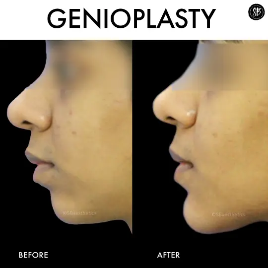 Chin Surgery