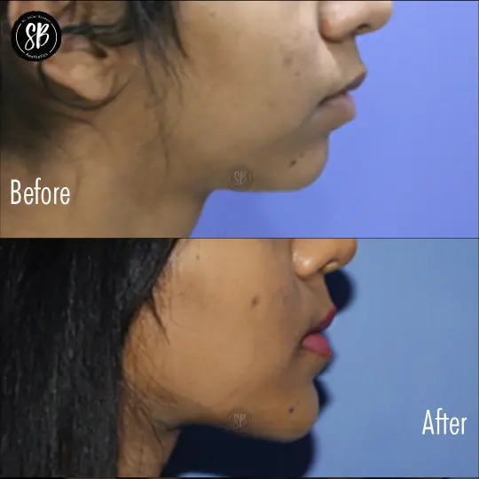 Chin Surgery