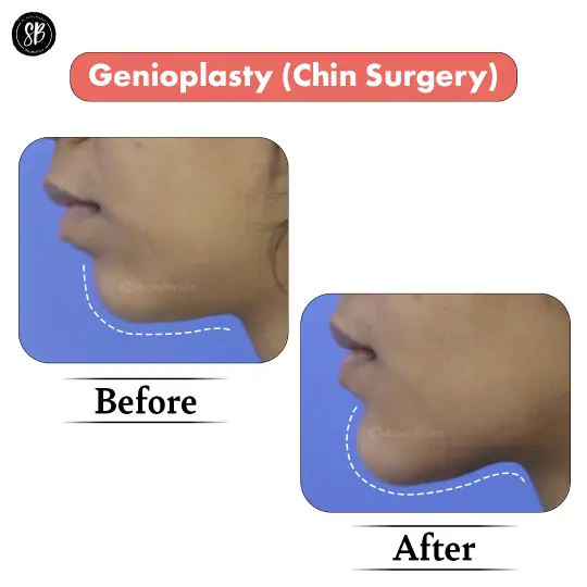 Chin Surgery