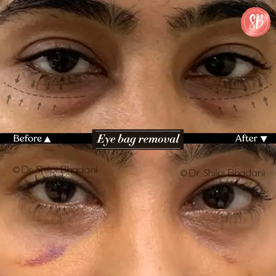 Blepharoplasty