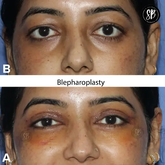 Blepharoplasty