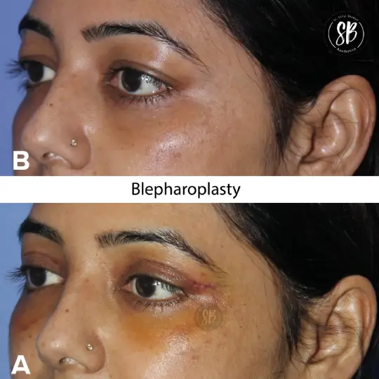 Blepharoplasty