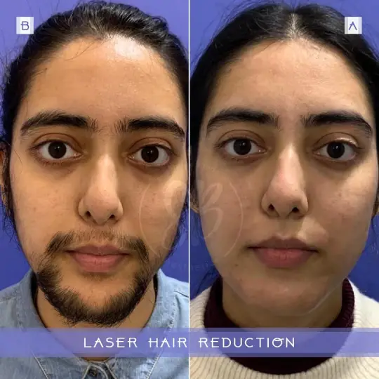 Laser Hair Removal