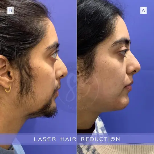 Laser Hair Removal