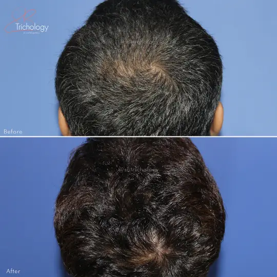 Hair Transplant