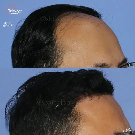 Hair Transplant