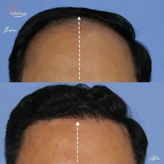 Hair Transplant