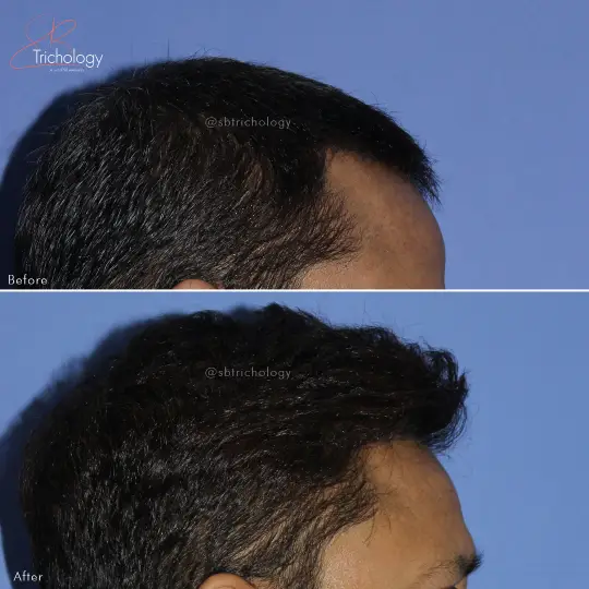 Hair Transplant