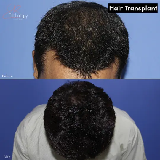 Hair Transplant