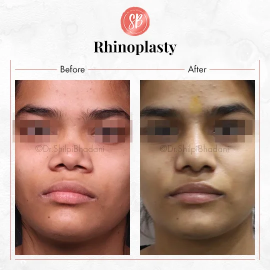 Rhinoplasty Before & After