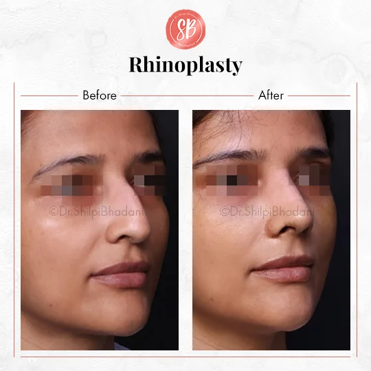 Rhinoplasty Before & After