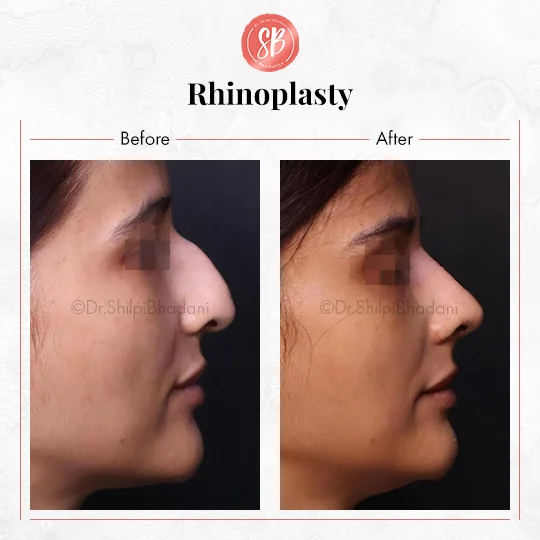 Rhinoplasty Before & After