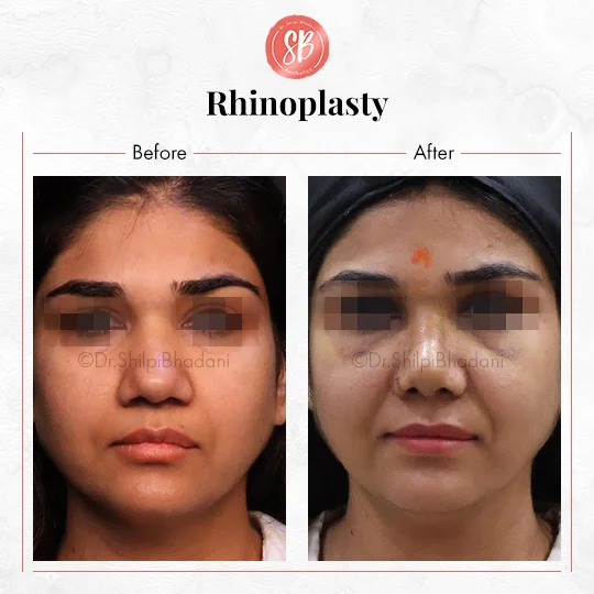 Rhinoplasty Before & After