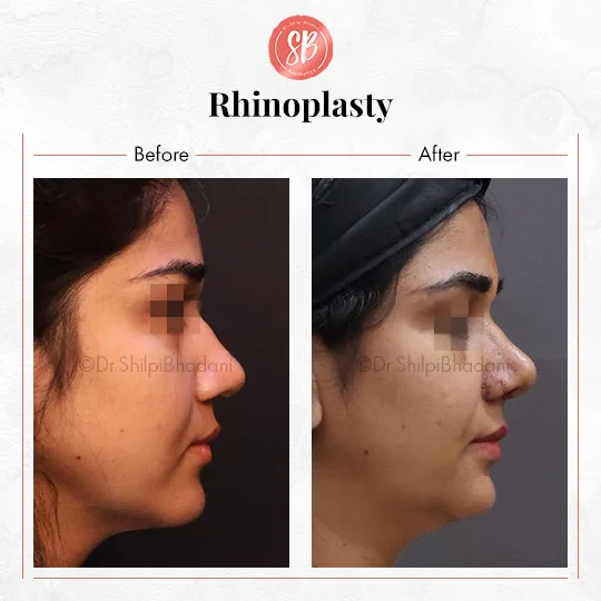 Rhinoplasty Before & After