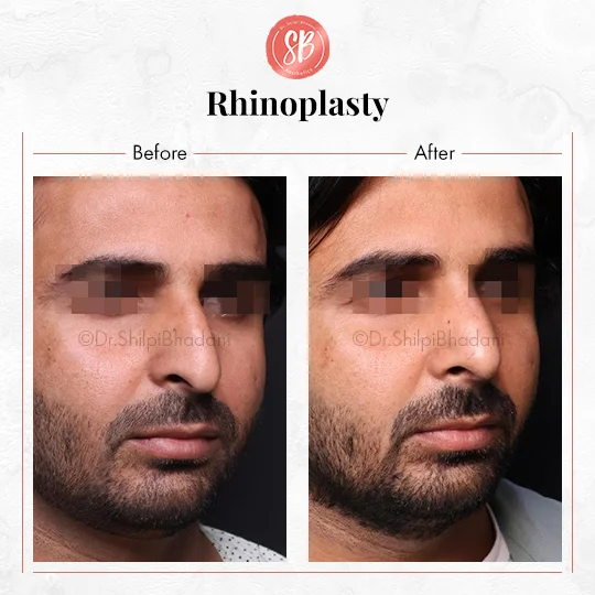 Rhinoplasty Before & After