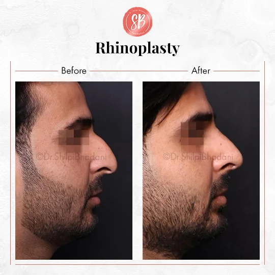 Rhinoplasty Before & After