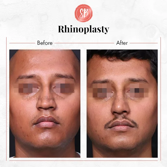 Rhinoplasty Before & After