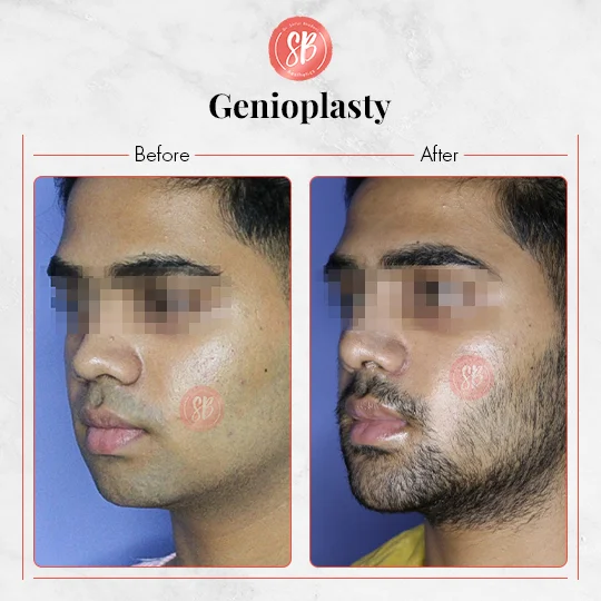 Genioplasty