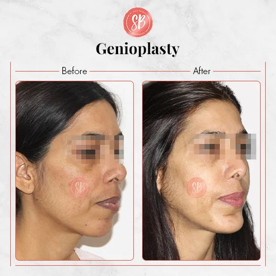 Genioplasty
