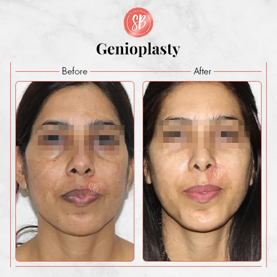 Genioplasty