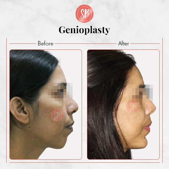 Genioplasty