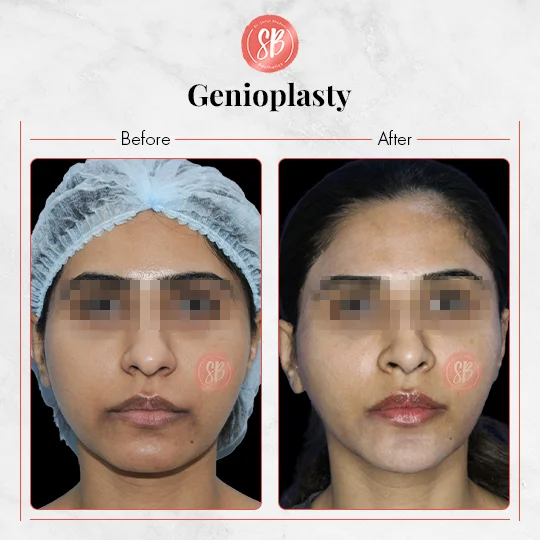 Genioplasty
