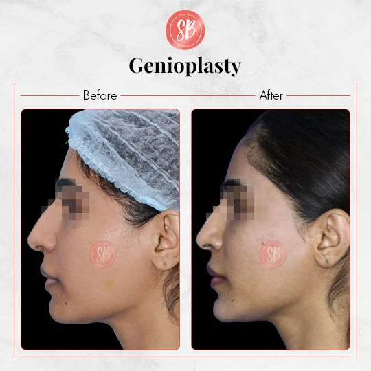 Genioplasty
