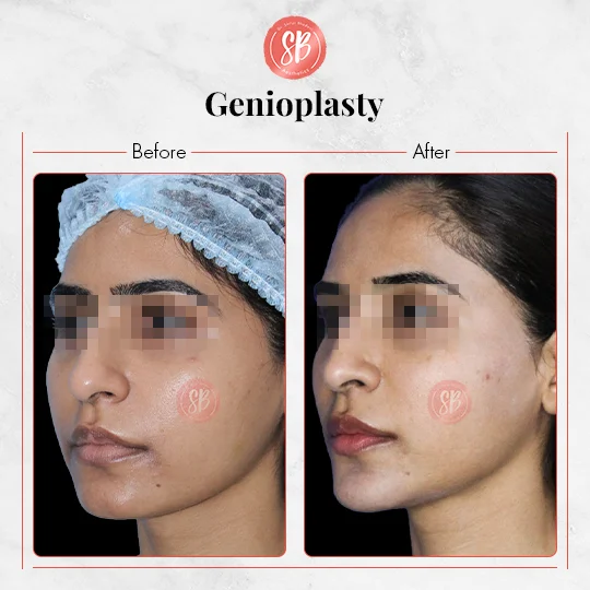 Genioplasty