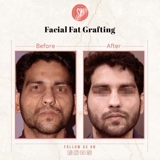 Facial Fat Grafting