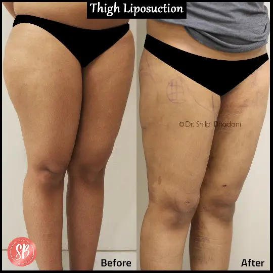 Liposuction