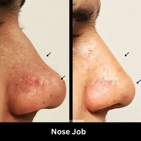 Rhinoplasty