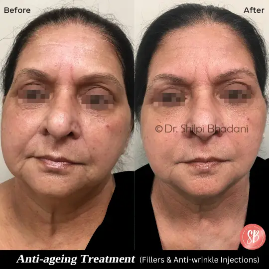 Anti Wrinkle Injections