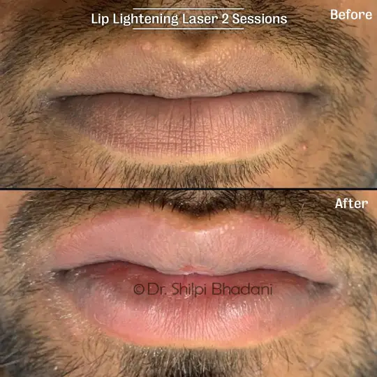 Lip Treatments