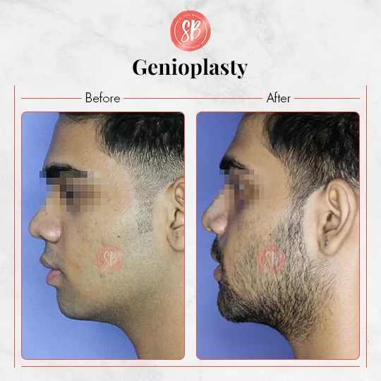 Genioplasty