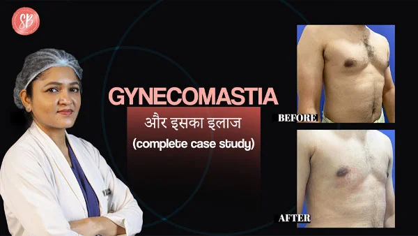 Gynecomastia